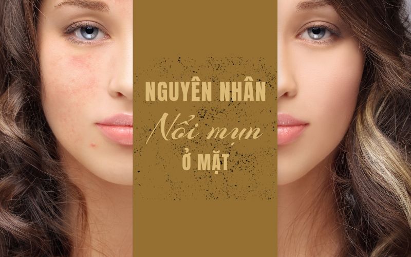 Tìm hiểu 7 nguyên nhân nổi mụn ở mặt thường gặp nhất