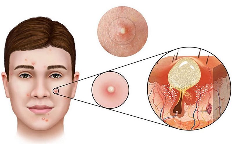 Mụn đầu trắng trên mặt xuất hiện khi bã nhờn bị tích tụ lâu ngày