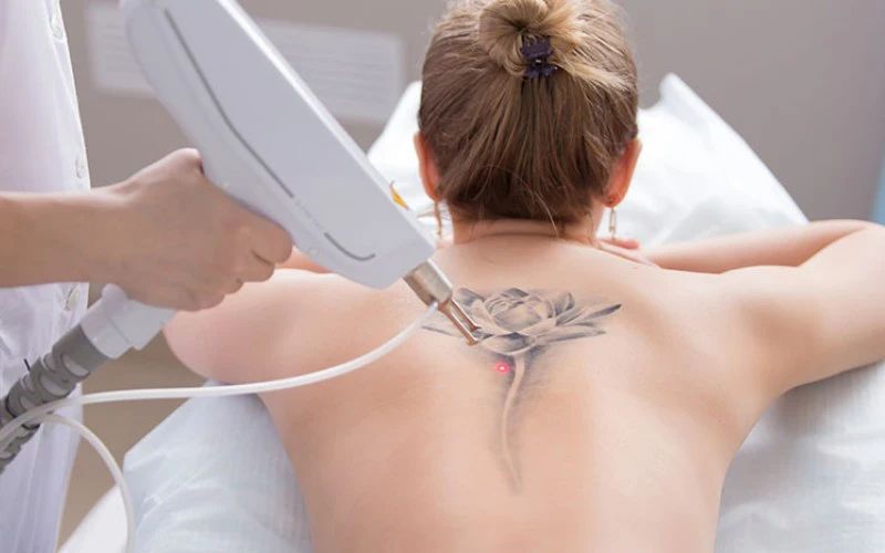 Xóa xăm bằng laser hiệu quả cao và ít gây tổn thương da