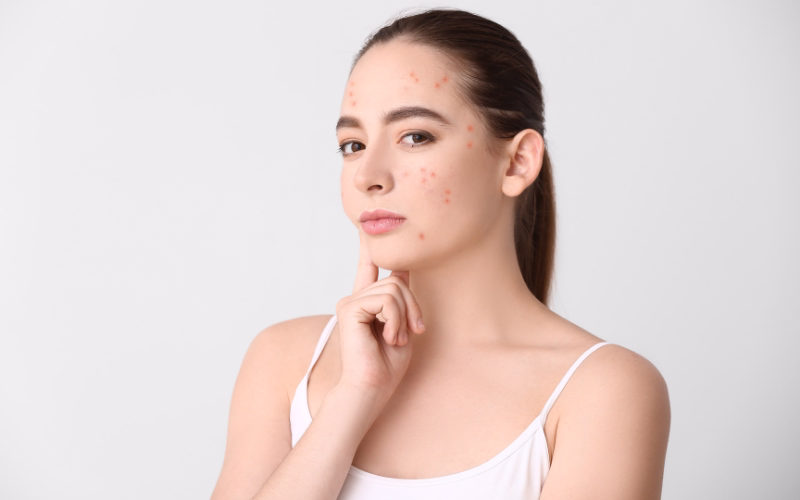 Xông mặt không đúng cách có thể khiến da bị nổi mụn nhiều hơn